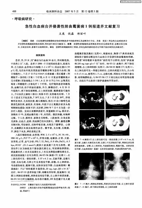 急性白血病合并侵袭性肺曲霉菌病1例报道并文献复习