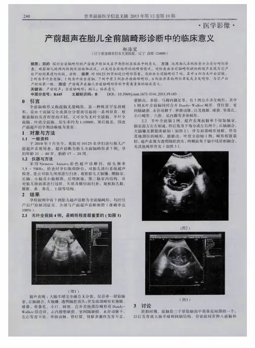产前超声在胎儿全前脑畸形诊断中的临床意义