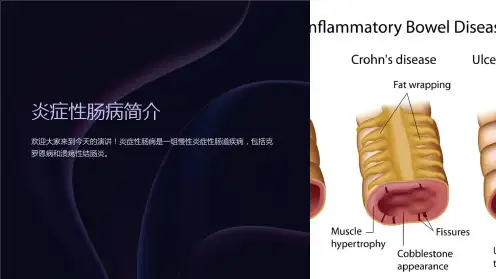 内科学：炎症性肠病(临床医学)PPT