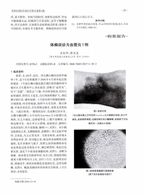 体癣误诊为血管炎1例