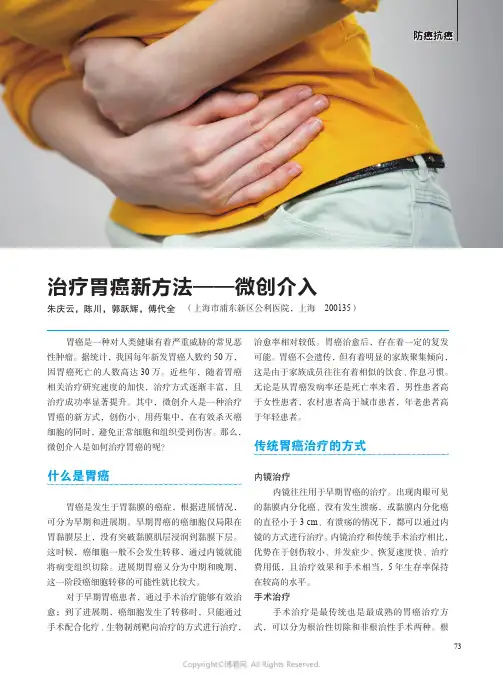 211066749_治疗胃癌新方法——微创介入