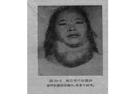 单纯性甲状腺肿Simple Goiter