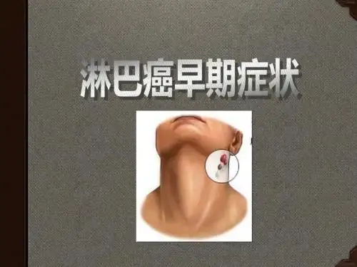 淋巴癌早期症状