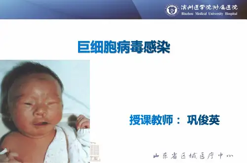 巨细胞病毒感染