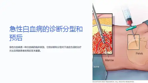 急性白血病的诊断分型和预后
