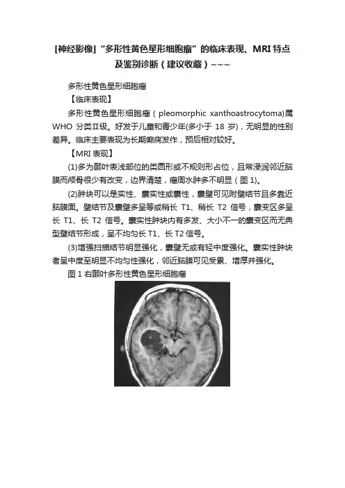 [神经影像]“多形性黄色星形细胞瘤”的临床表现、MRI特点及鉴别诊断（建议收藏）~~~