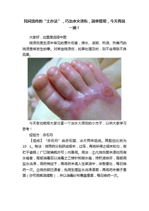 民间流传的“土办法”，巧治水火烫伤，简单管用，今天再说一遍！
