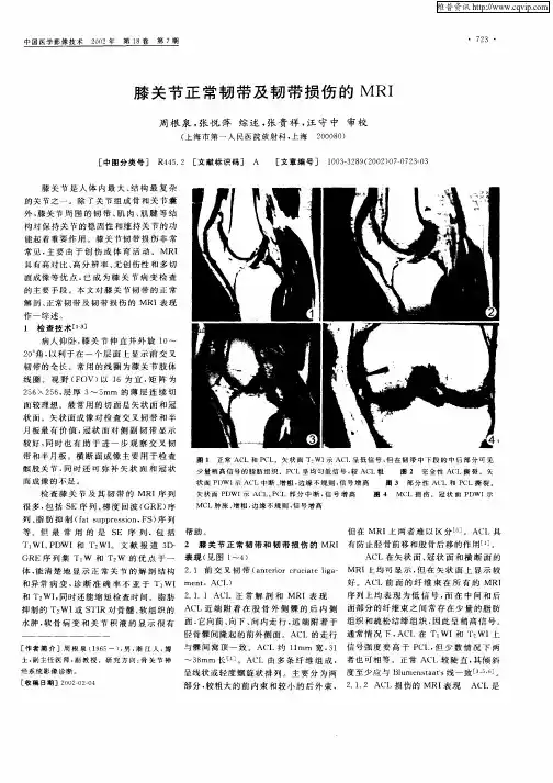 膝关节正常韧带及韧带损伤的MRI