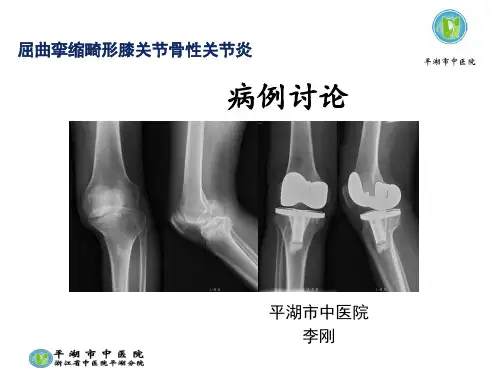 屈曲挛缩畸形膝关节骨性关节炎PPT课件