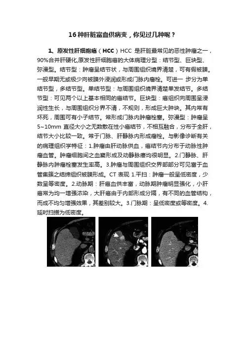 16种肝脏富血供病变，你见过几种呢？