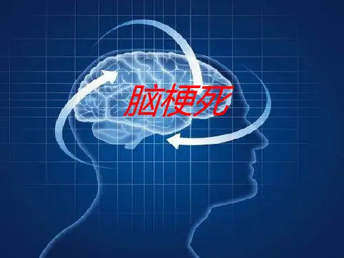 脑梗死ppt课件
