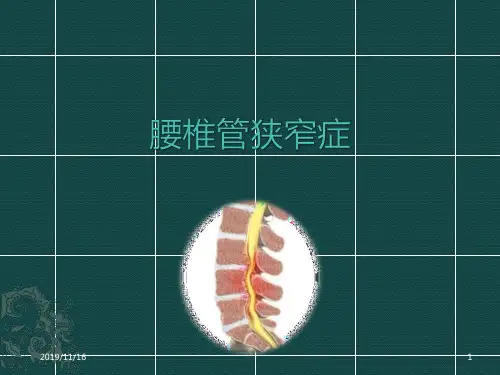 腰椎管狭窄症PPT课件