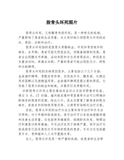 股骨头坏死图片