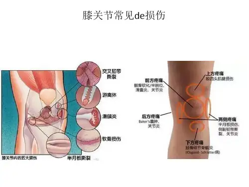 膝关节常见的损伤