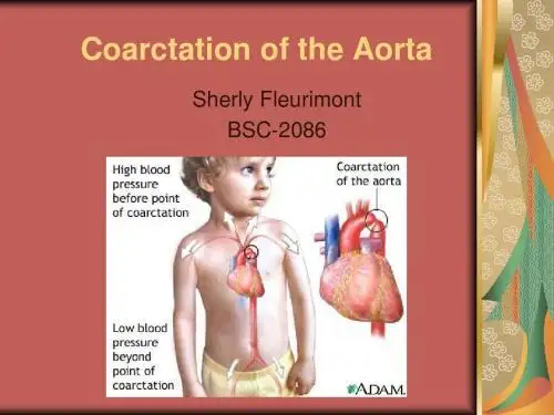 最新主动脉缩窄(Coarctation of the Aorta)-药学医学精品资料