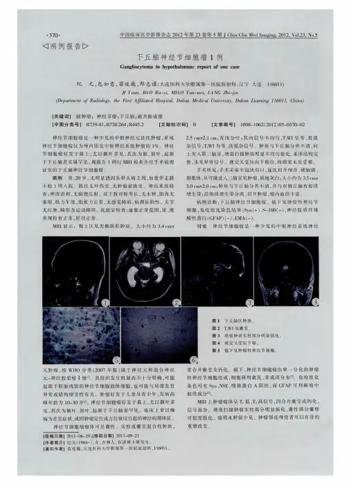 下丘脑神经节细胞瘤1例