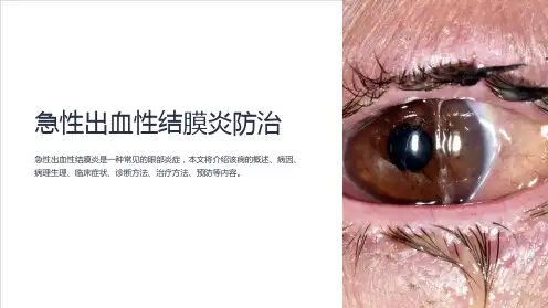 急性出血性结膜炎防治