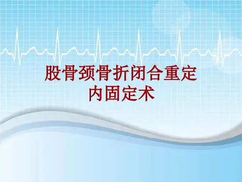 手术讲解模板：股骨颈骨折闭合重定内固定术