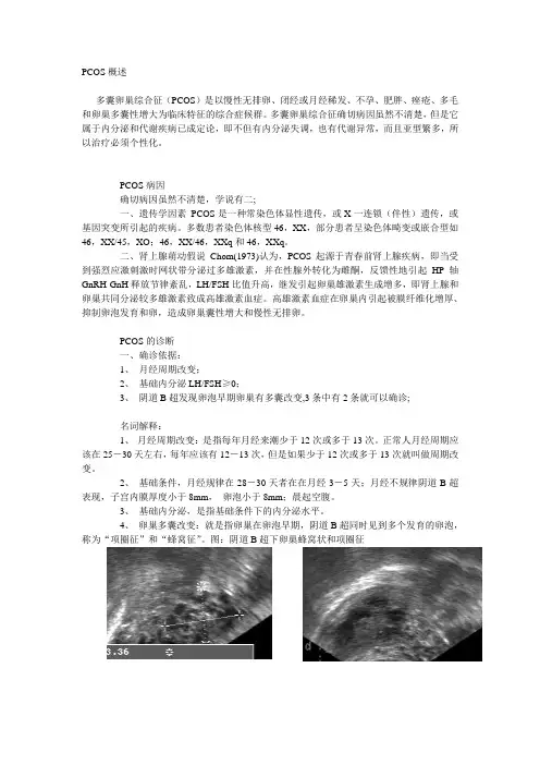 多囊卵巢综合征