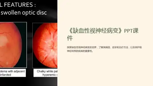 《缺血性视神经病变》课件