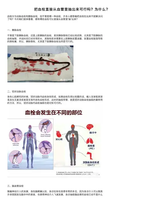 把血栓直接从血管里抽出来可行吗？为什么？