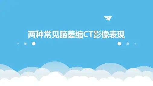 两种常见脑萎缩CT影像表现