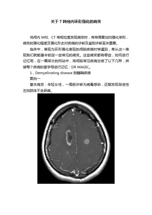 关于7种颅内环形强化的病变