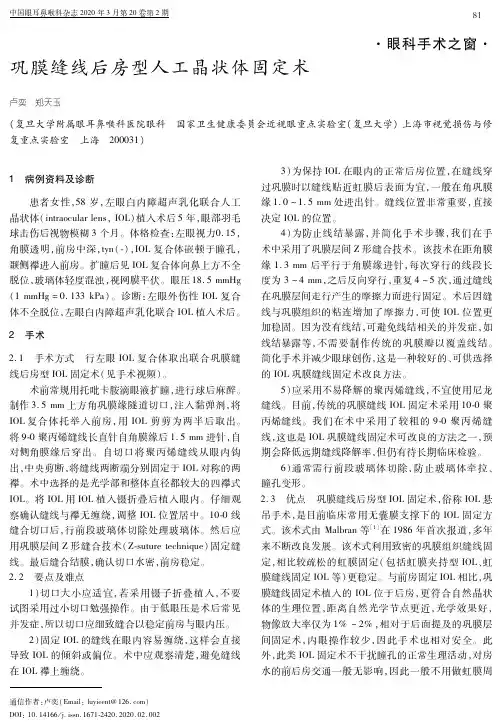 巩膜缝线后房型人工晶状体固定术