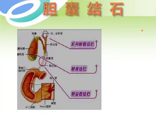 胆囊结石护理PPT课件