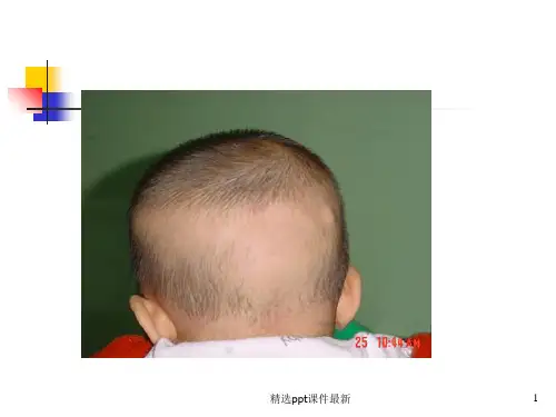 佝偻病PPT课件