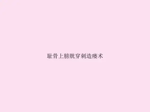 耻骨上膀胱穿刺造瘘术