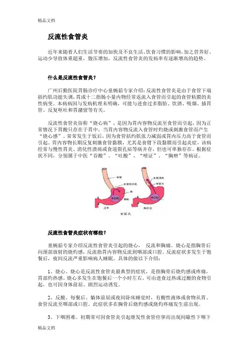 (整理)反流性食管炎.