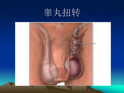 睾丸扭转_2