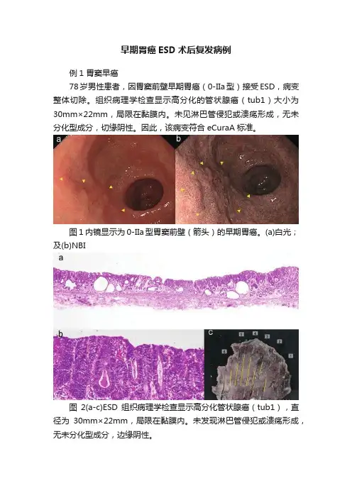 早期胃癌ESD术后复发病例
