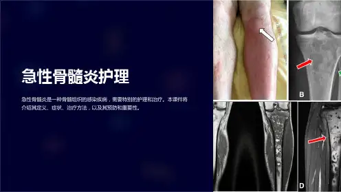 “急性骨髓炎护理”课件
