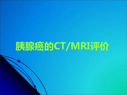 胰腺癌CT和MRI评价