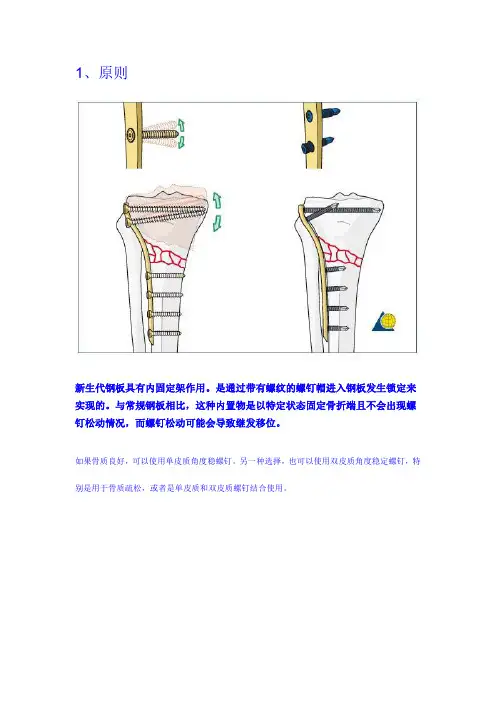 手术-胫骨平台A3型骨折LCP(LISS)内固定术