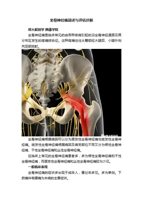 坐骨神经痛简述与评估诊断