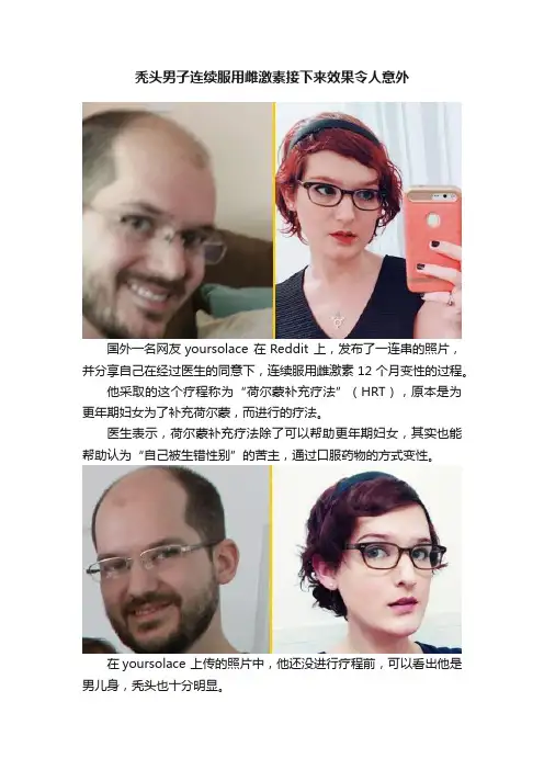 秃头男子连续服用雌激素接下来效果令人意外