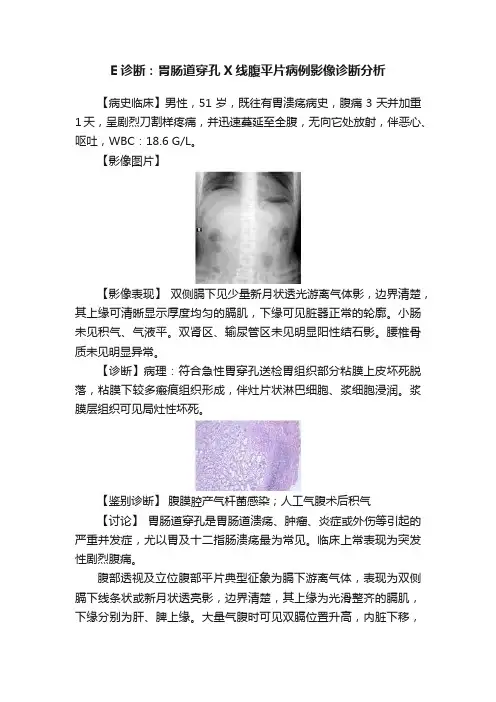 E诊断：胃肠道穿孔X线腹平片病例影像诊断分析