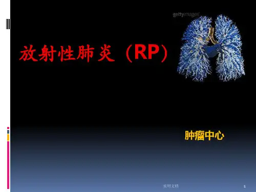 放射性肺炎(RP)