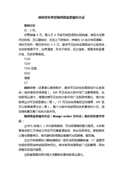 病例赏析典型脑颜面血管瘤综合征