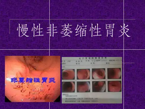 慢性非萎缩性胃炎图片和用药讲解PPT课件