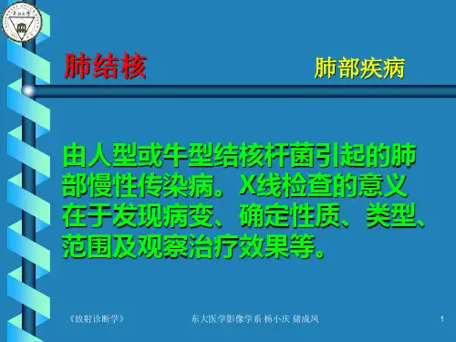 肺结核的影像诊断