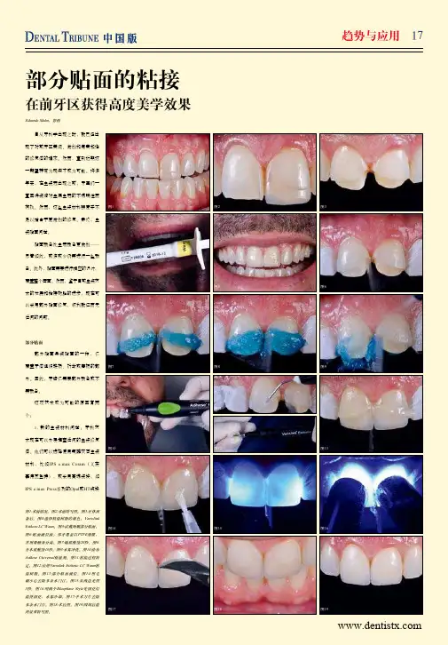 部分贴面的粘接