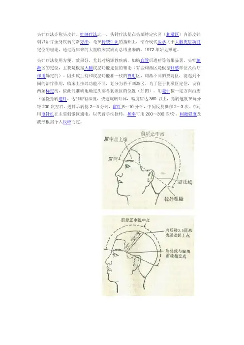 头针疗法亦称头皮针