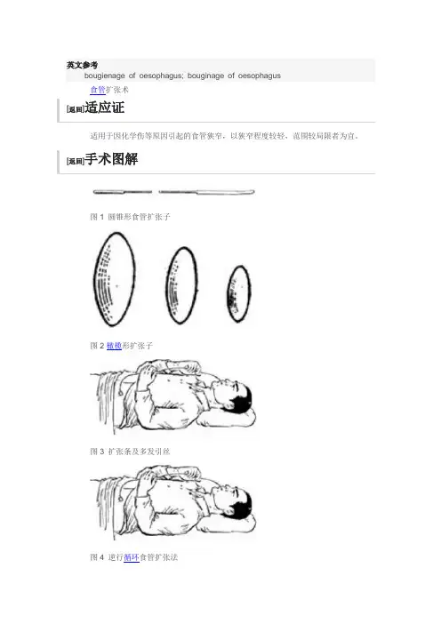 食管扩张术