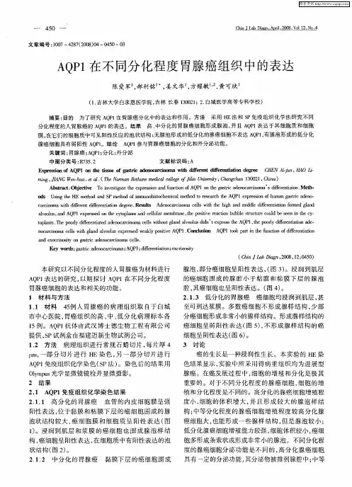 AQP1在不同分化程度胃腺癌组织中的表达