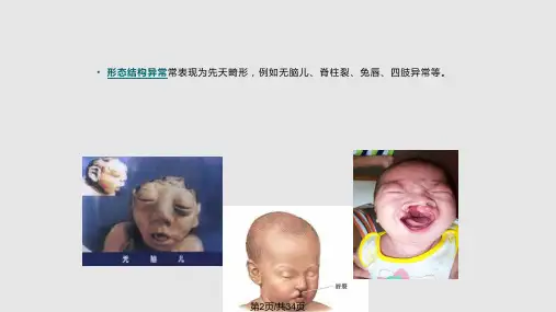 预防出生缺陷基本知识.pptx