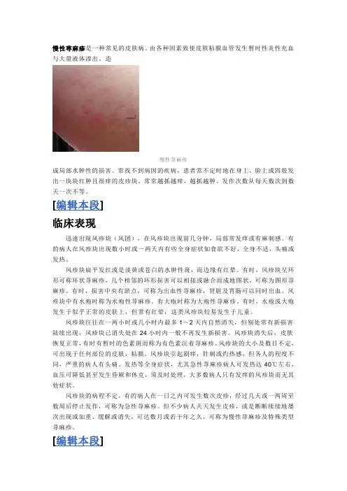慢性荨麻疹是一种常见的皮肤病